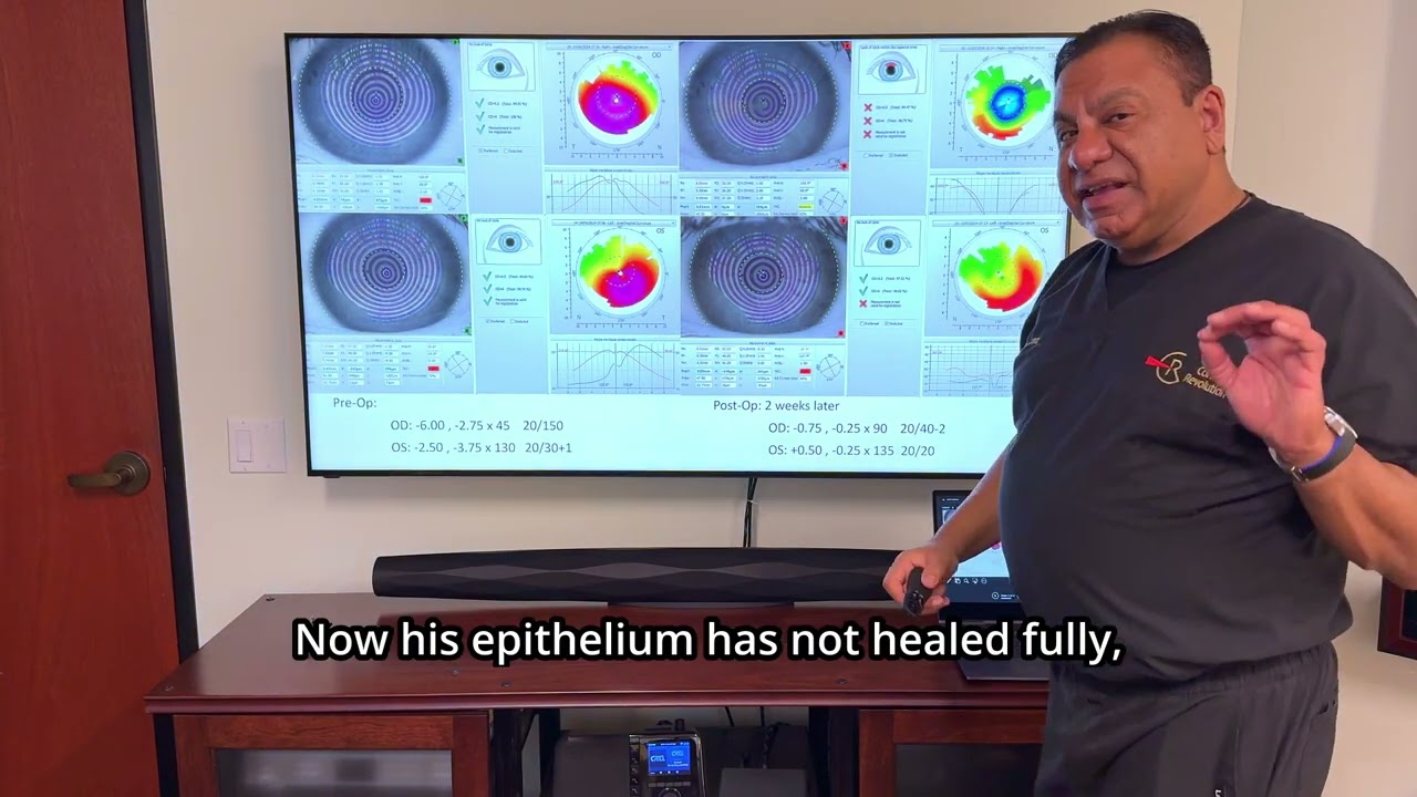 Keratoconus Treatment Results with CREATE Protocol and Crosslinking with Dr. Motwani