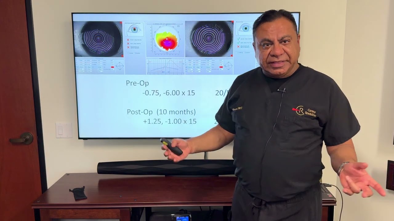 Keratoconus Treatment Results with Topography and Overall Correction