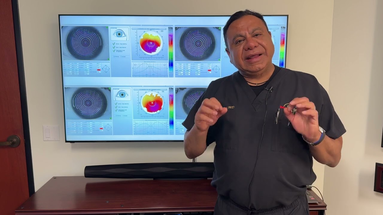 Amazing Keratoconus Results and Permanent Cure (Crosslinking and CREATE Protocol) Virtually No Cone!