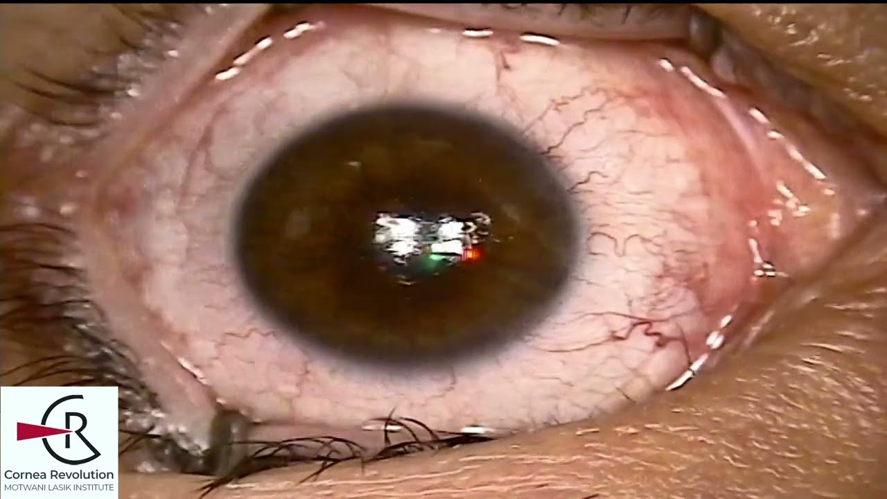 Excimer Laser with Riboflavin for Correcting Keratoconus