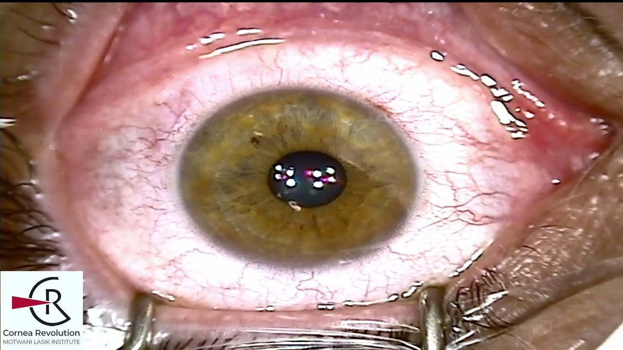 Laser Correction for Keratoconus Patient