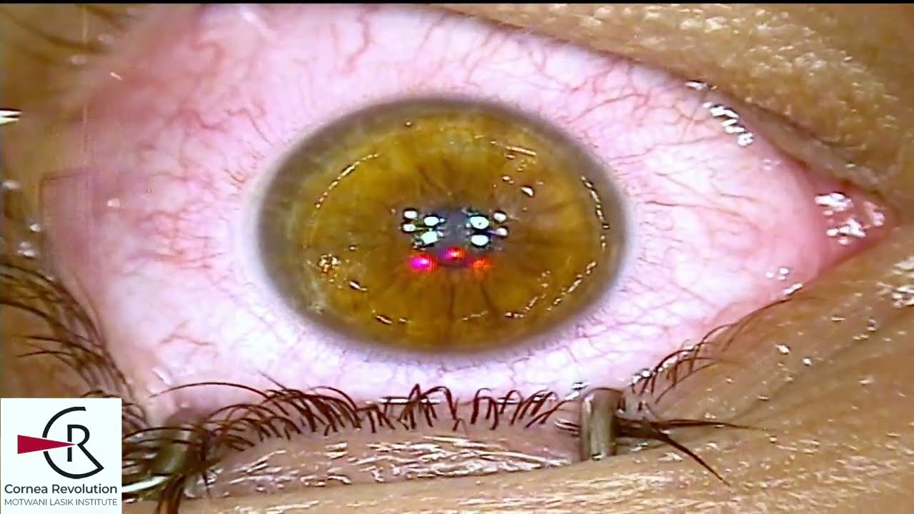 The CREATE Protocol for Keratoconus Treatment