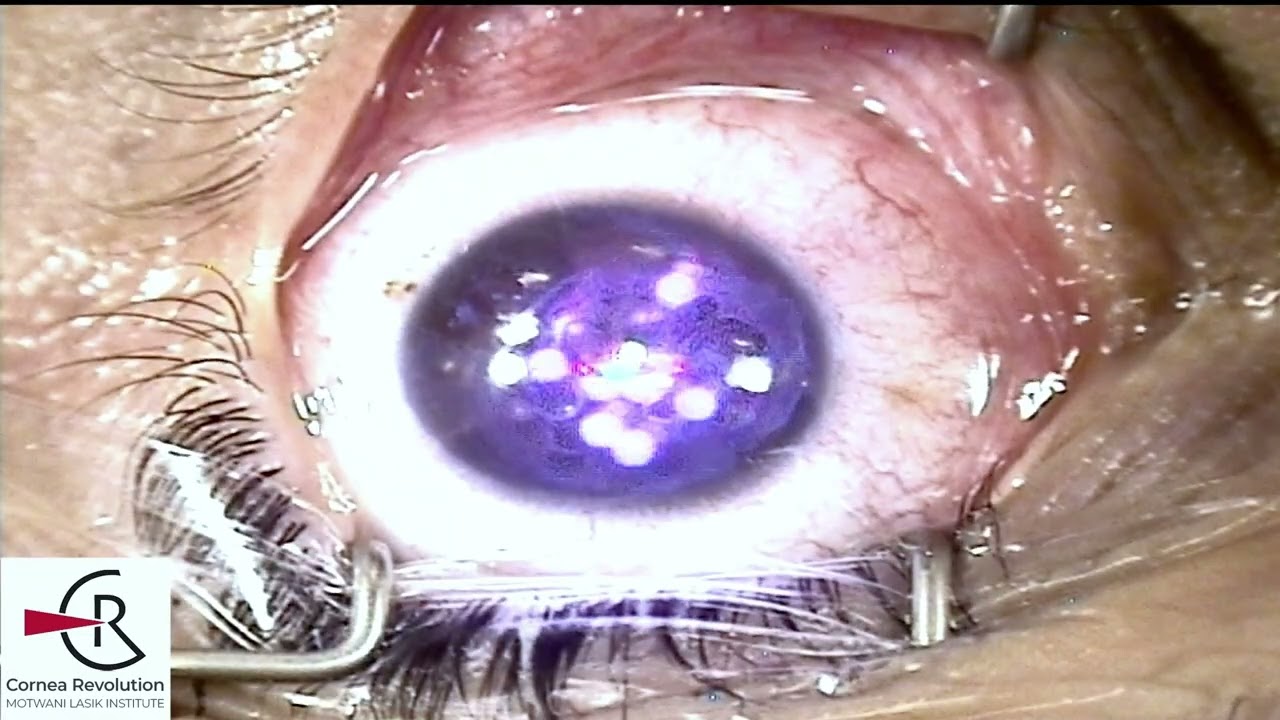 Keratoconus Vision Correction with Riboflavin Treatment